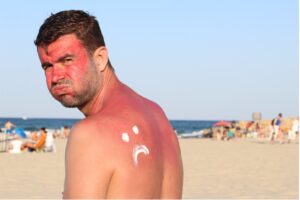 Man after sunburn