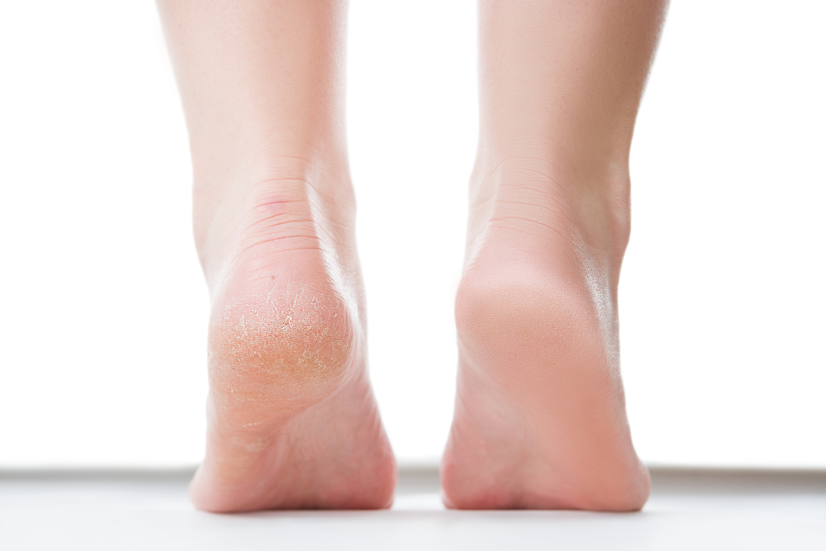 How to Permanently Heal & Get Rid of Cracked Heels for Good - Foot and  Ankle Group