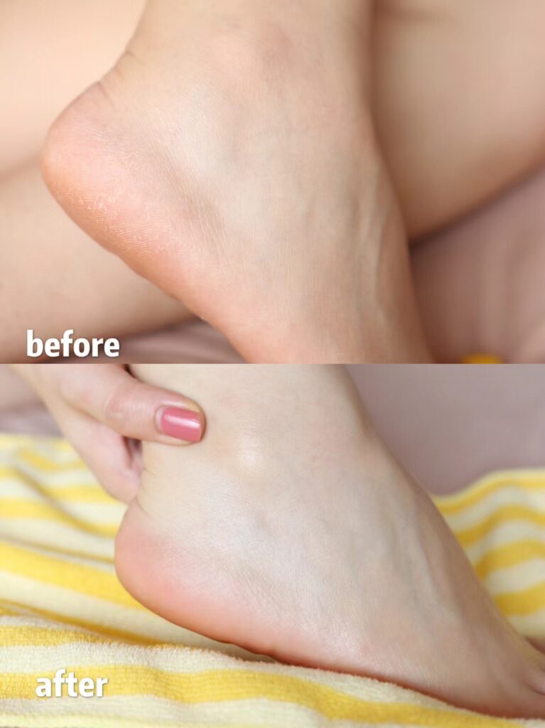 Before and After DU'IT heel balm