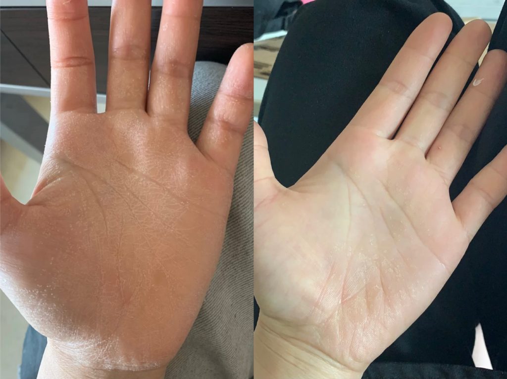 DU'IT Tough Hands can fix symptoms of dermatitis 