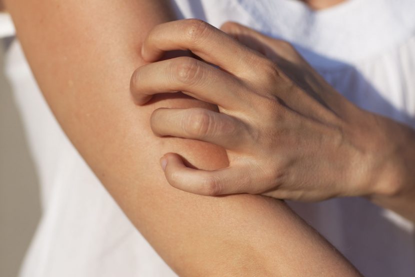 What is the difference between eczema and dermatitis