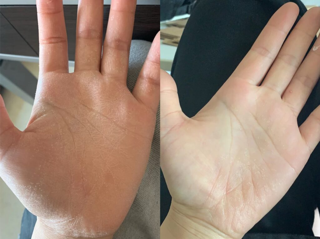 Before and After using DU'IT tough hands 