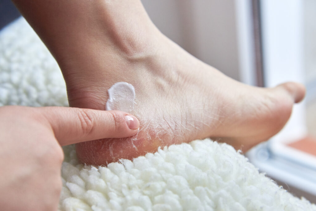 Weather, improper care, wrong shoes can all cause cracked & dry heels 