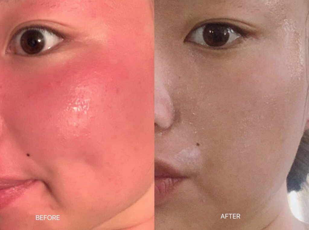 Before and After Sunburn VE+ Face Cream
