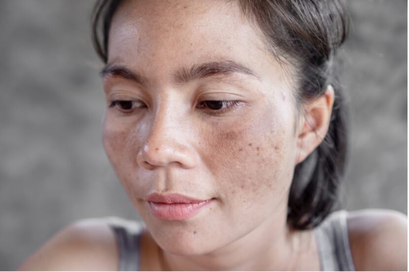 Does vitamin e fade acne and dark spots
